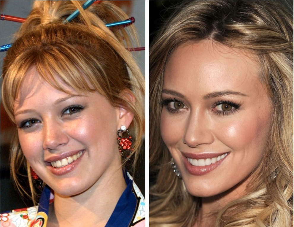 denti hilary duff