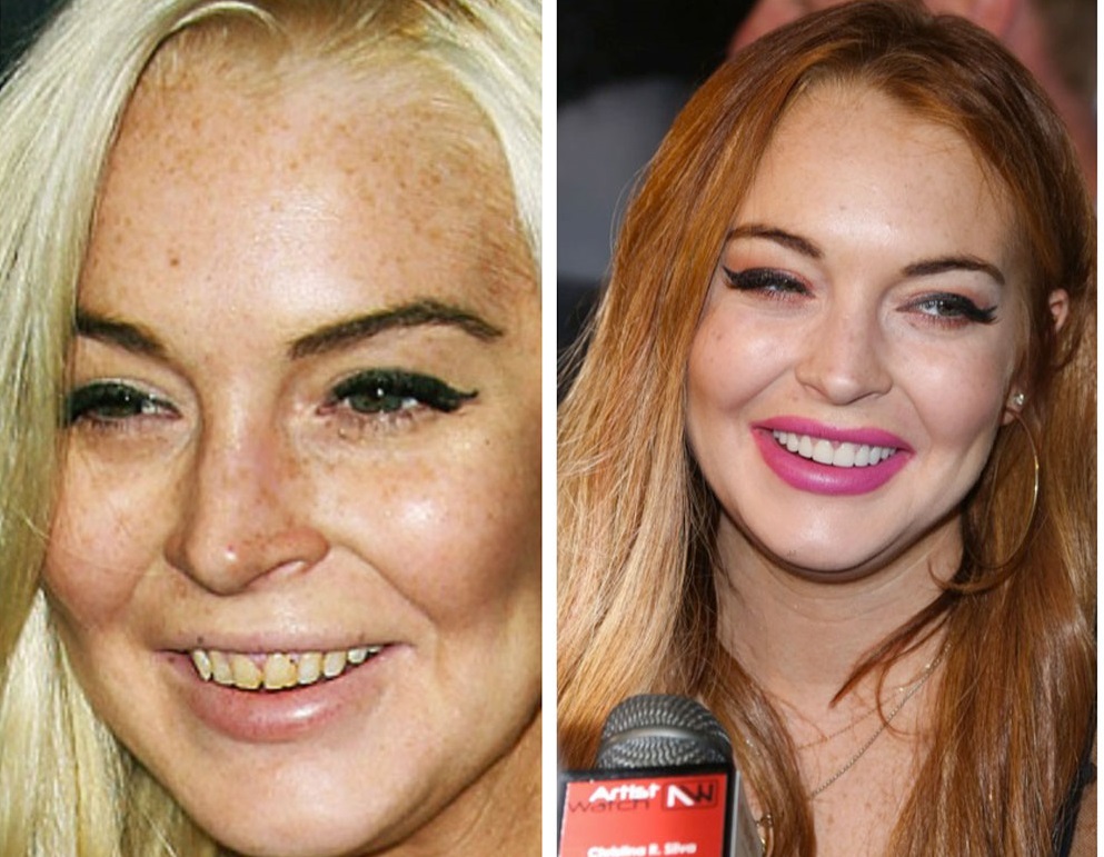 denti-lindsaylohan