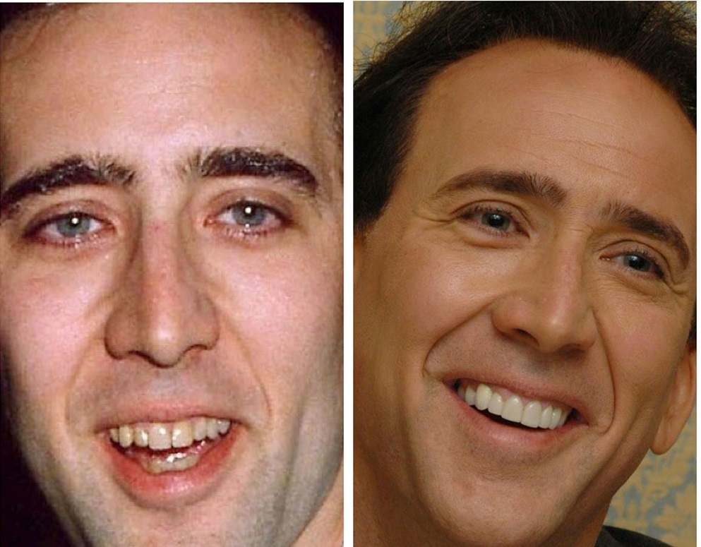 denti nicholas cage