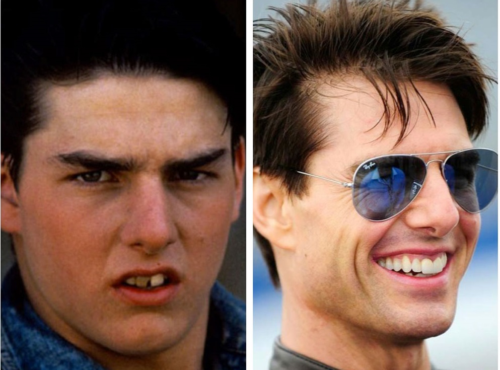 denti tom cruise