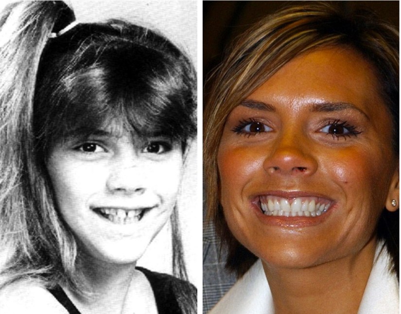 denti victoriabeckham